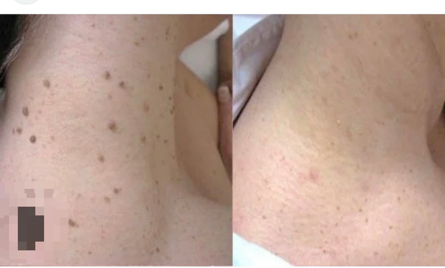 Image 3: Removal of 1, 2, or 3 Skin Tags, Angiomas, Milia, or Age Spots
