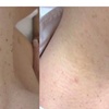 Image 3: Removal of 1, 2, or 3 Skin Tags, Angiomas, Milia, or Age Spots