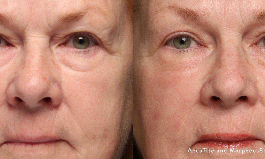 Image 6: Radiant Skin Awaits: Transform with Morpheus8 RF Technology!