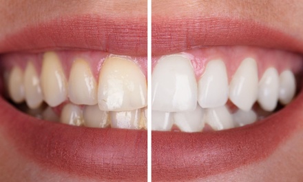 Dental Exam, Cleaning, X-Rays as needed, and Oral Cancer Screening - Family Crown Dentistry