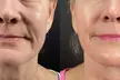 Up to 82% Off for Morpheus8 and Morpheus8 Body Radio-Frequency Skin Tightening at Victoria Med Spa - Second Medium