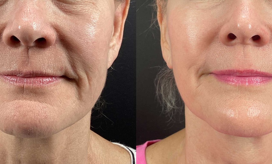 Image 2: Radiant Skin Awaits: Transform with Morpheus8 RF Technology!