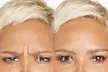 Transform your skin w/t a Smooth, Youthful Look w/t Xeomin: 20 Units at BG Medical Aesthetics & Beautiful Glow at Hilton - Second Medium
