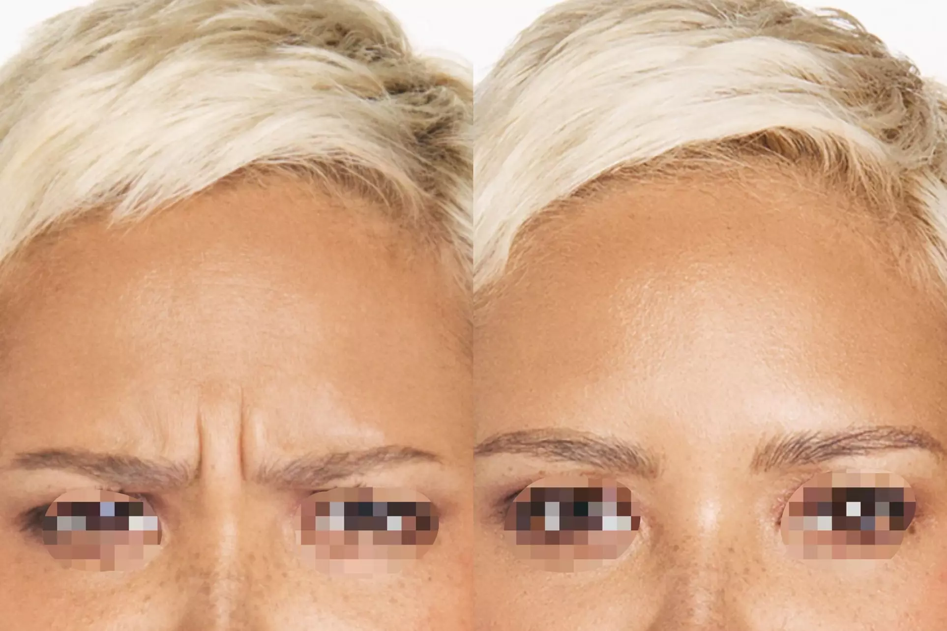 Achieve a Smooth, Youthful Look with Xeomin: 20 Units