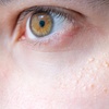 Image 1: Up to 50% Off on Plasma Pen Treatment at Gentlelase Laser Aesthetics