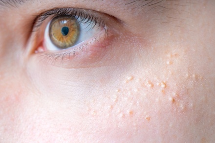 Removal Up To 5 Skin Tags, Cherry Angiomas, Age Spots, Sun Spots or Milia with Plasma Pen - Gentlelase Laser Aesthetics