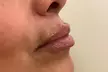 Smooth & Contour with The Skin Room's One or Full CC Syringe of Revanesse Versa Filler (Up to 28%Off) - Second Medium