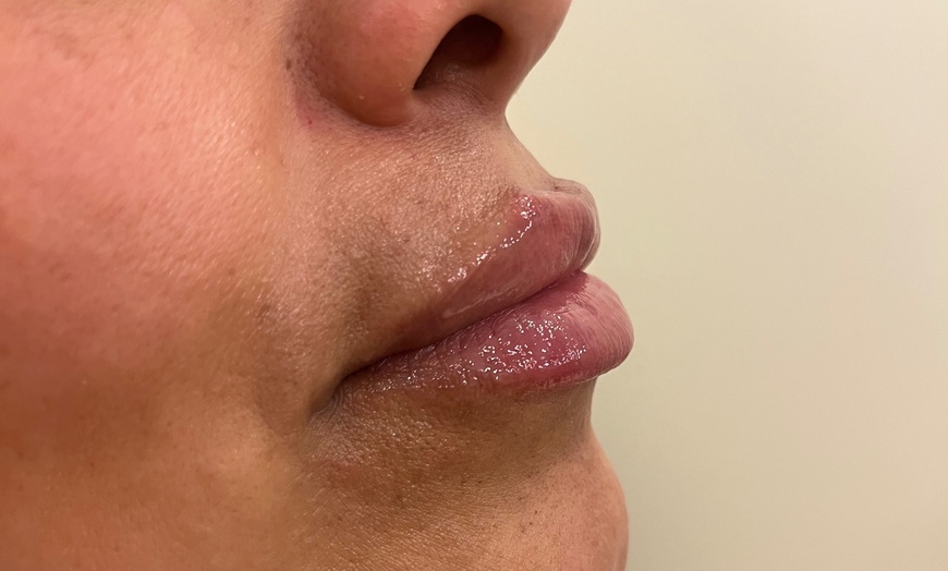 Image 2: Smooth & Contour: One or Full CC Syringe of Revanesse Versa Filler