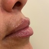 Image 2: Smooth & Contour: One or Full CC Syringe of Revanesse Versa Filler
