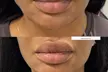 Enhance Your Look with Lip, Cheek or Chin Filler or a Russian Lip Flip Treatment (Up to 50% Off) - Second Medium