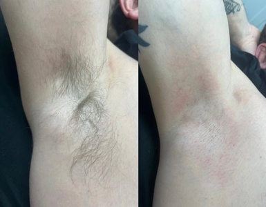 Upper lip wax - A.Esthetics