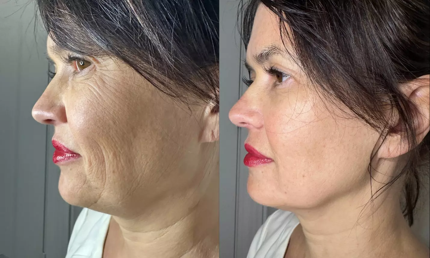 Radio Frequency Skin Tightening or Ultrasound Therapy Skin Tightening