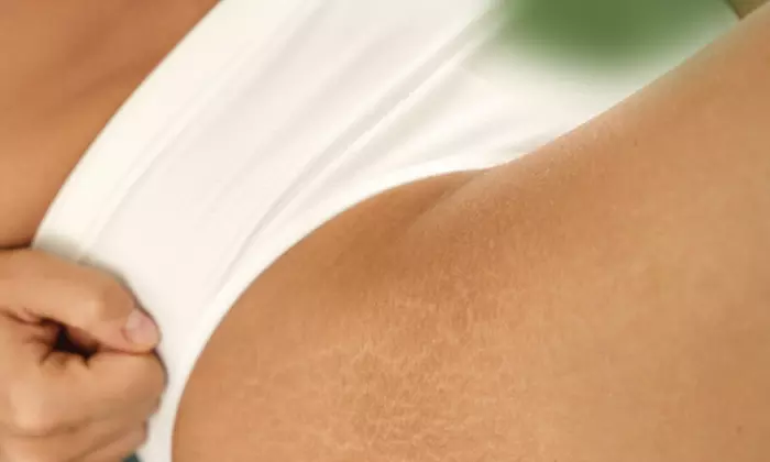 Up to 50% Off on Tattooing at Elev8 Ink-less Stretch Mark & Scar Medical Repair - Second Medium