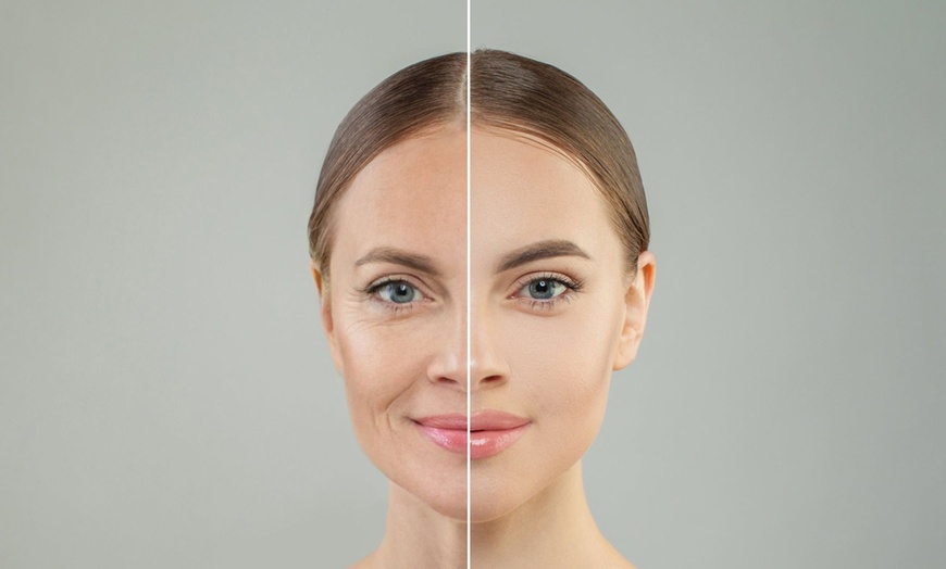 Image 2: Up to 79% Off on Facelift - Thread Lift at Turkish Royal Aesthetic