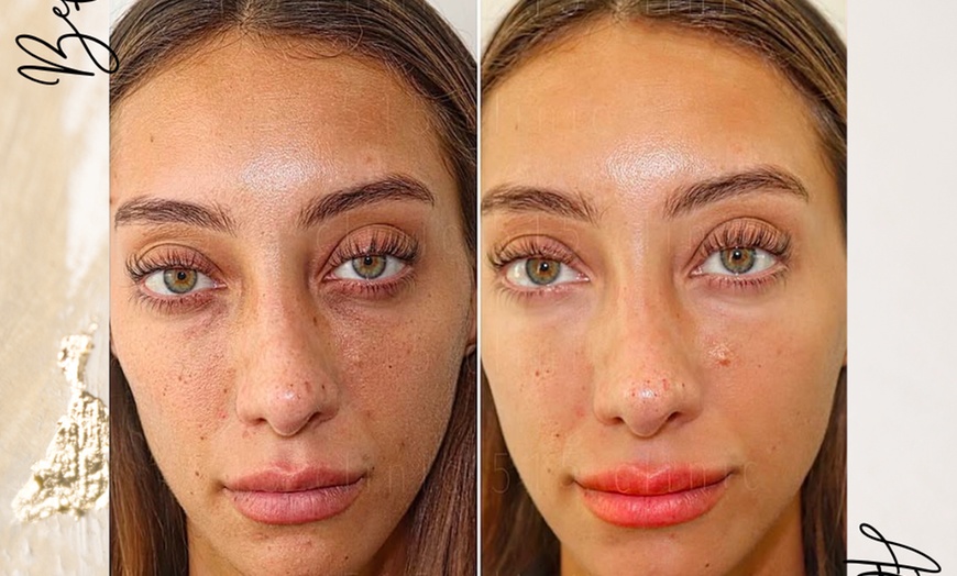 Image 7: Hydrate and Rejuvenate with Microneedling Treatments