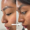 Image 1: Up to 57% Off on Injection - Dermal Filler at AK Medical Spa