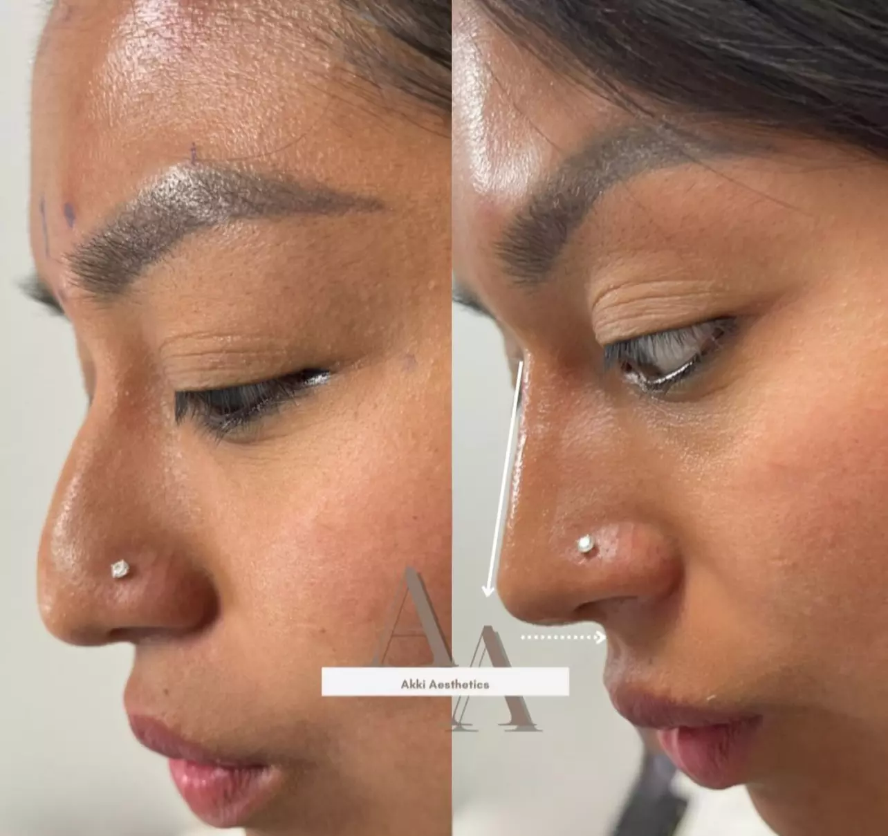 Up to 57% Off on Injection - Dermal Filler at Akki Aesthetics
