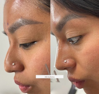 Liquid Nose Job - Revanesse Versa+ - AK Medical Spa
