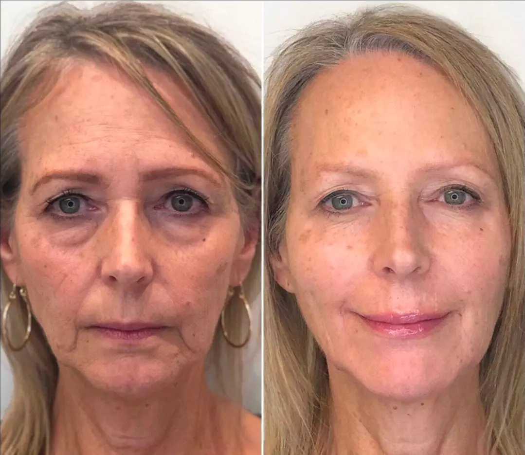 Rejuvenate Your Skin with a Diamond Microdermabrasion