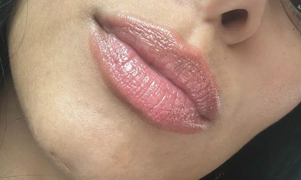 Revitalize Lips with Nano-Needle Enhancement + Opt Touch up 2 Weekst at ML ESTHETICS (Up To 30% Off) - Second Medium