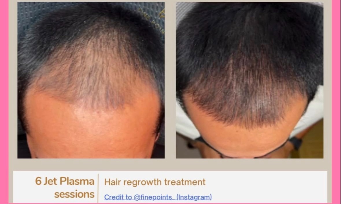 Up to 55% Off on Hair Restoration - Non-Surgical at Honey Skin Wellness