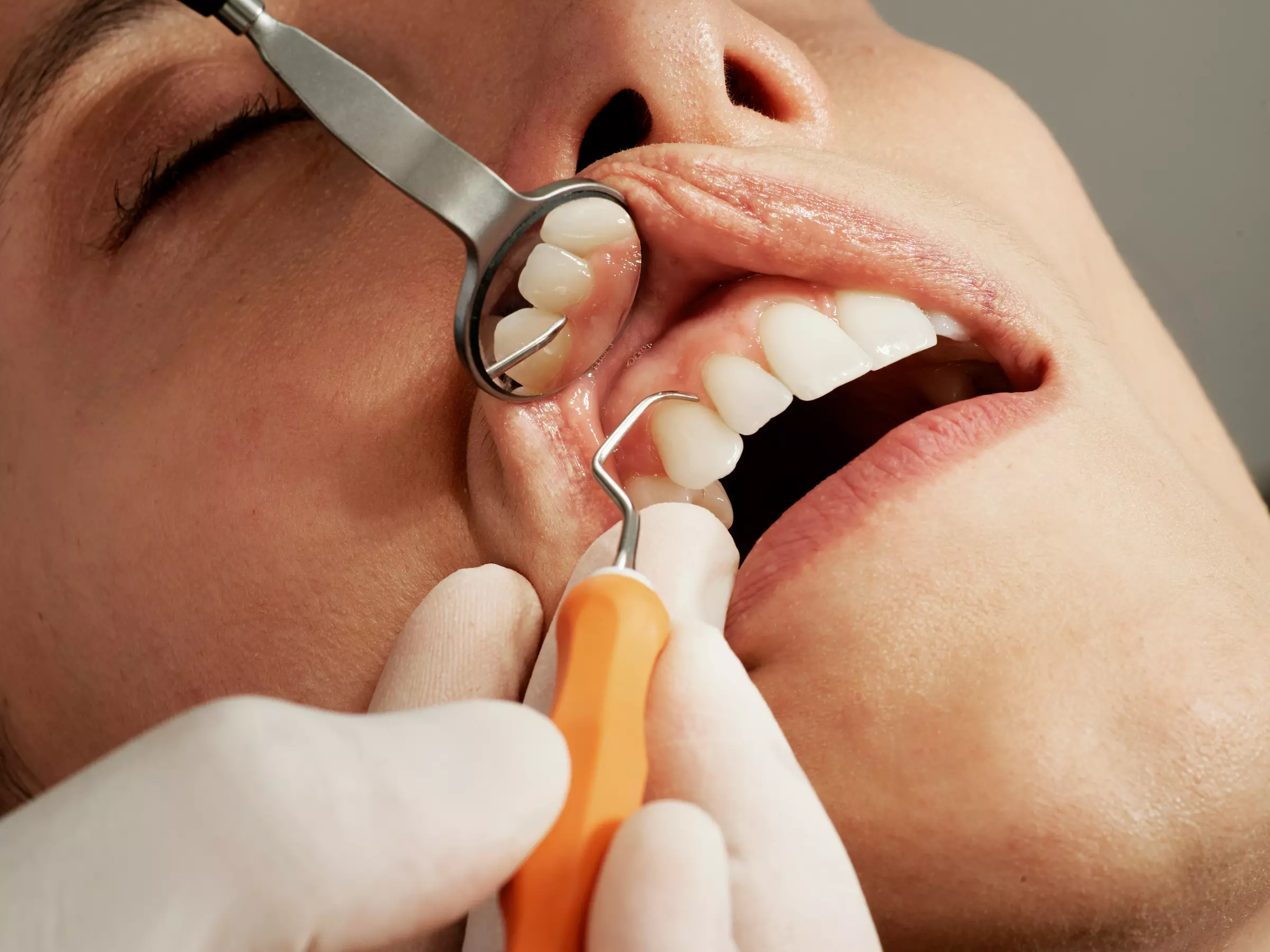 Dental Exam, Teeth Whitening, Membership, X-ray/Implant Package & More