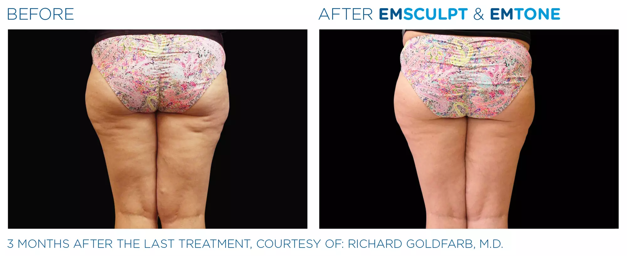 Up to 20% Off on Ultrasonic Fat Reduction at Jennifer R. Berman - Second Medium
