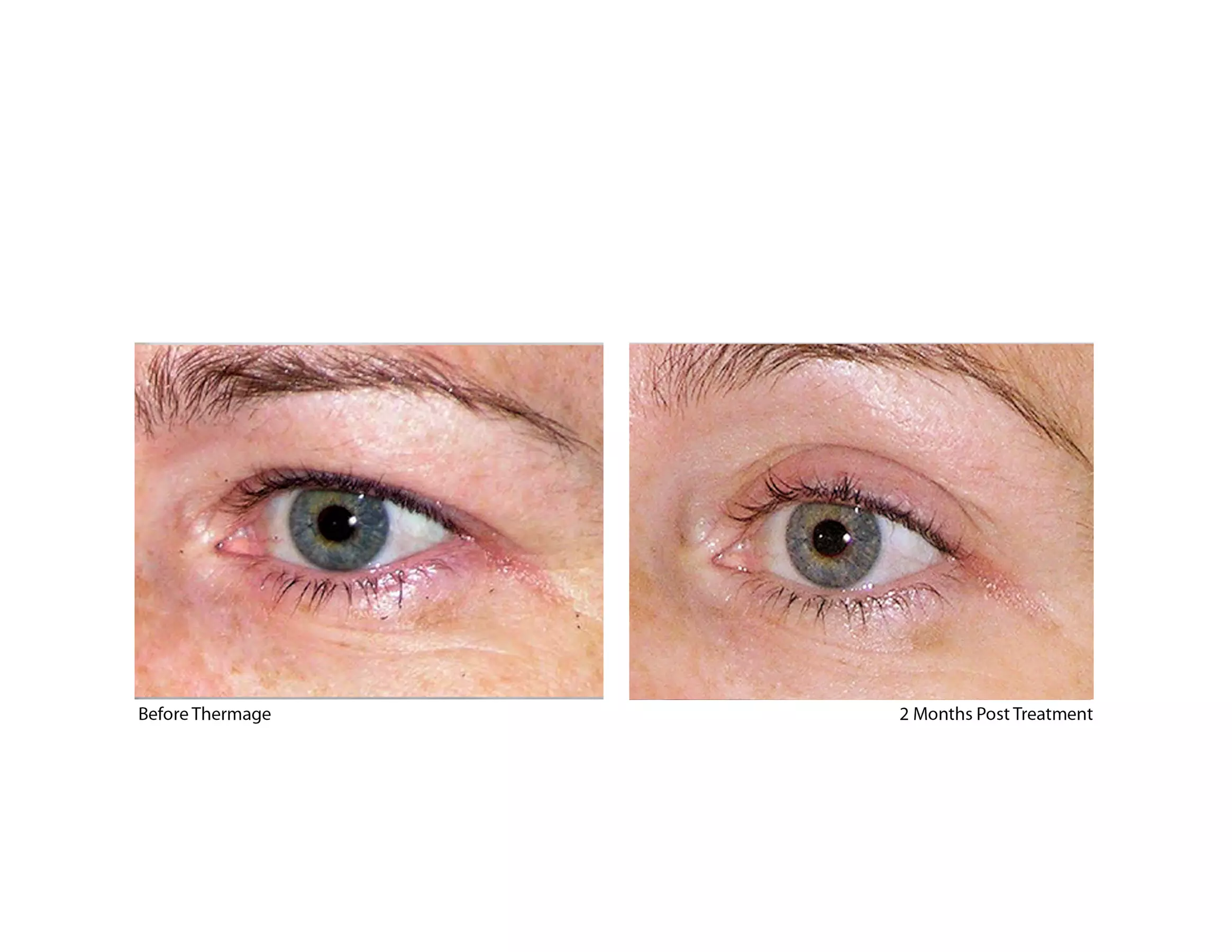 Experience Rewind Advanced Aesthetics'  Skin Tightening for Stomach, Eyes, Neck, or Knees (Up to 30% Off) - Second Medium