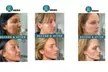 Enhance Your Look with Half (0.5 mL) or Full (1.0 mL) Syringe of RHA 3 at Dr Hero Medical (Up to 23% Off) - Second Medium