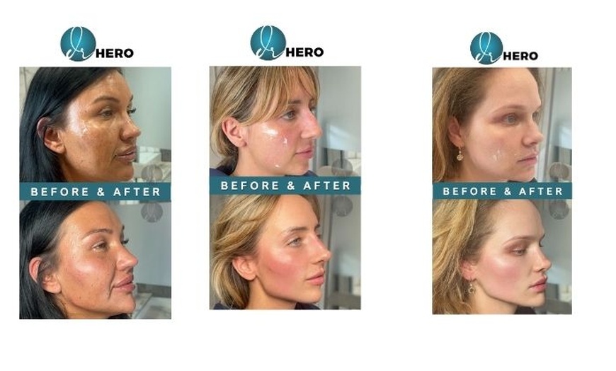 Image 2: Enhance Your Look with Half (0.5 mL) or Full (1.0 mL) Syringe of RHA 3