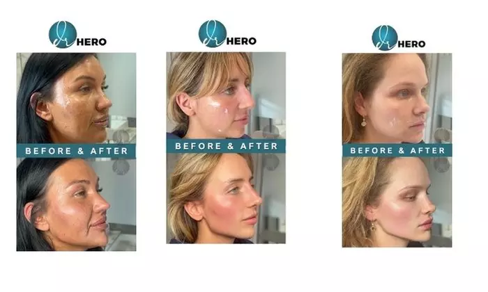 Enhance Your Look with Half (0.5 mL) or Full (1.0 mL) Syringe of RHA 3