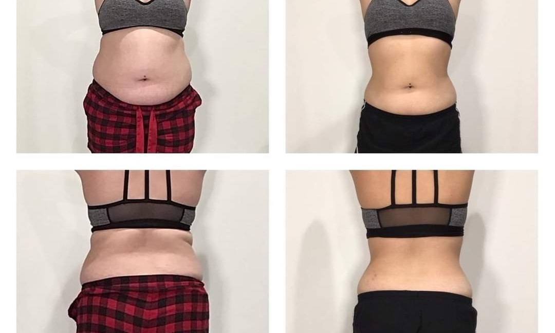 Cryo Liposculpt Intro Sessions for Various Body Areas of Your Choice