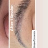 Image 1: Non-Invasive Eyebrow Magnetic Tattoo Removal