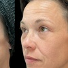 Image 1: One Fraxel Laser Skin Resurfacing Treatment for Neck or Full Face