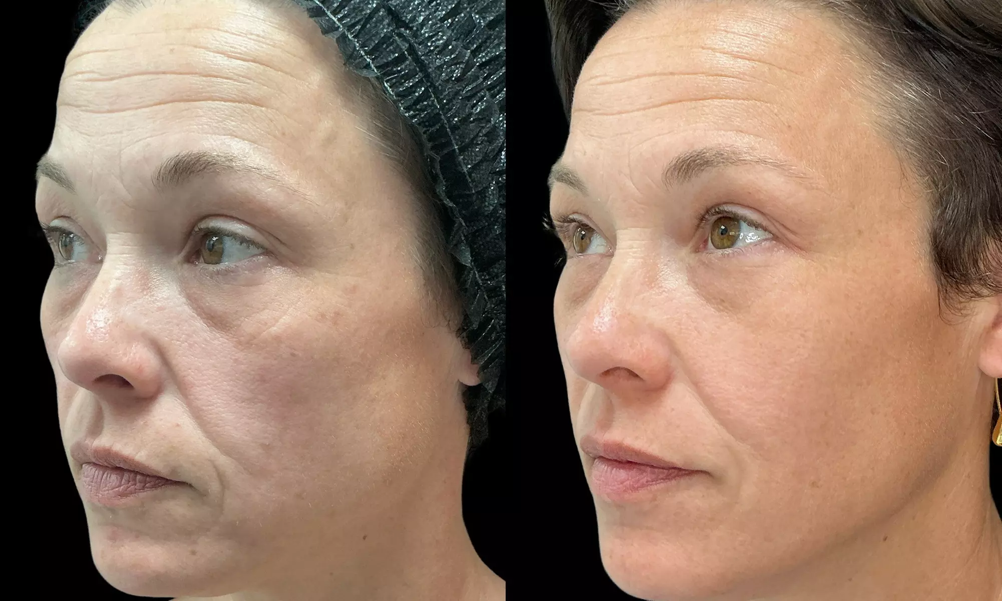 One Fraxel Laser Skin Resurfacing Treatment for Neck or Full Face at Diamond Advanced Aesthetics (Up to 45% Off) - Primary Image