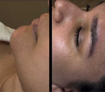 One Session of Microdermabrasion - Rima Beauty Spa
