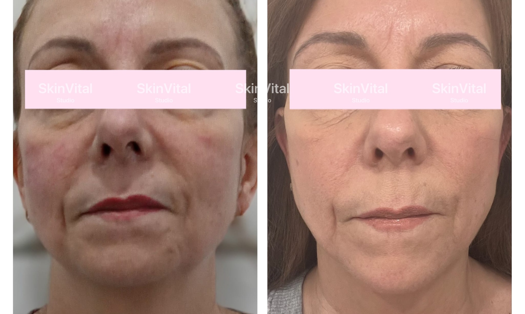 Targeted HIFU Lifting for Chin, Face, or Abdomen