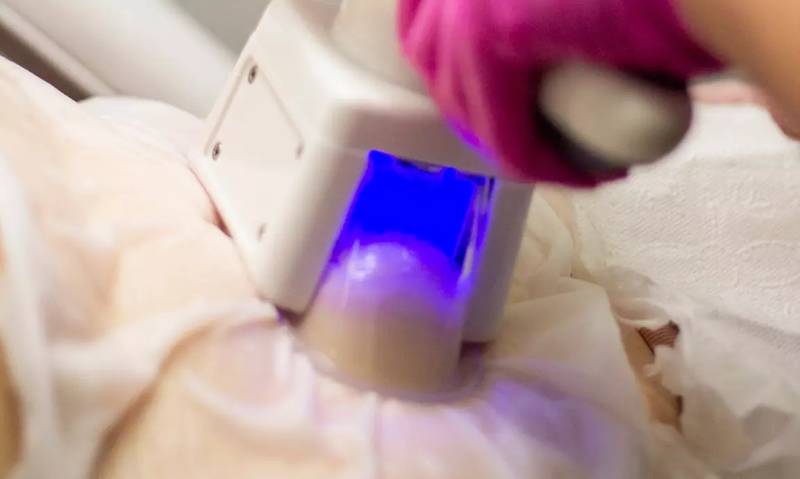 Redukcja tkanki tłuszczowej z kriolipolizą na wybraną partię ciała