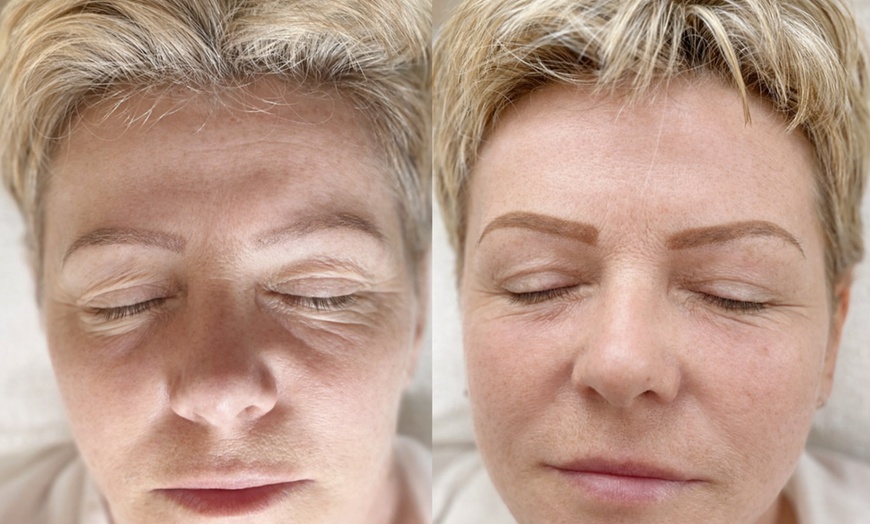 Image 3: Revitalize with One, Three, or Six Sessions of Micro-needling