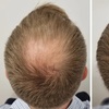 Image 2: Scalp Micropigmentation Hair-Loss Treatment - Crown, Front, or Filler