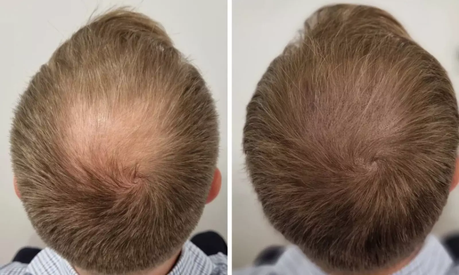 Scalp Micropigmentation Hair-Loss Treatment - Crown, Front, or Filler
