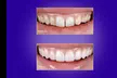 Achieve a Radiant Smile with Custom Professional Teeth Whitening Treatment at StarSmiles (Up to 33% Off) - Second Medium
