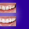 Image 3: Transform Your Smile with Custom Teeth Whitening