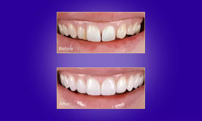 Transform Your Smile with Custom Teeth Whitening
