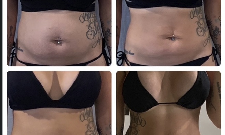 Image 5: Single Session of BodyFX or MiniFX Fat Reduction and Skin Tightening