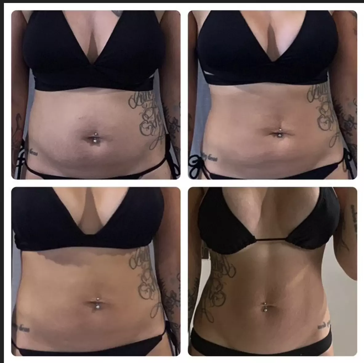 Single Session of BodyFX or MiniFX Fat Reduction and Skin Tightening