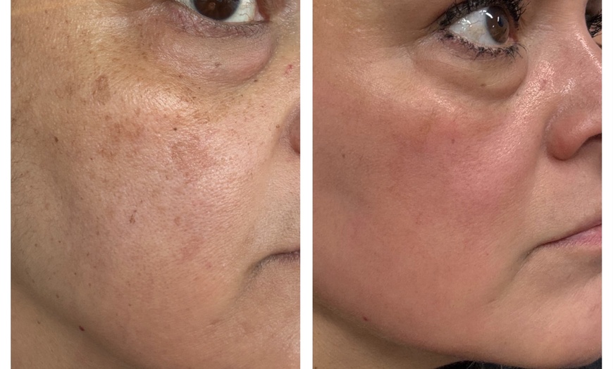 Image 8: Transform Your Skin with One or Three CO2 Skin-Resurfacing Sessions