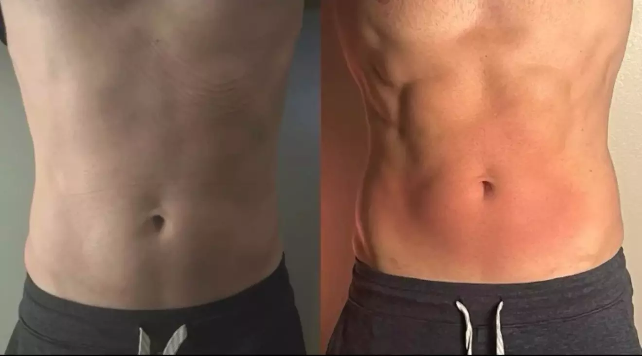 Non-Surgical Solution: Fix Stubborn Fat with Lipo Sculpt Lite