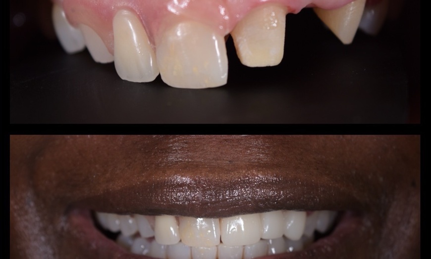 Image 9: Dental Crowns, Dental Exam, X-rays & Cleaning, Dentures & More