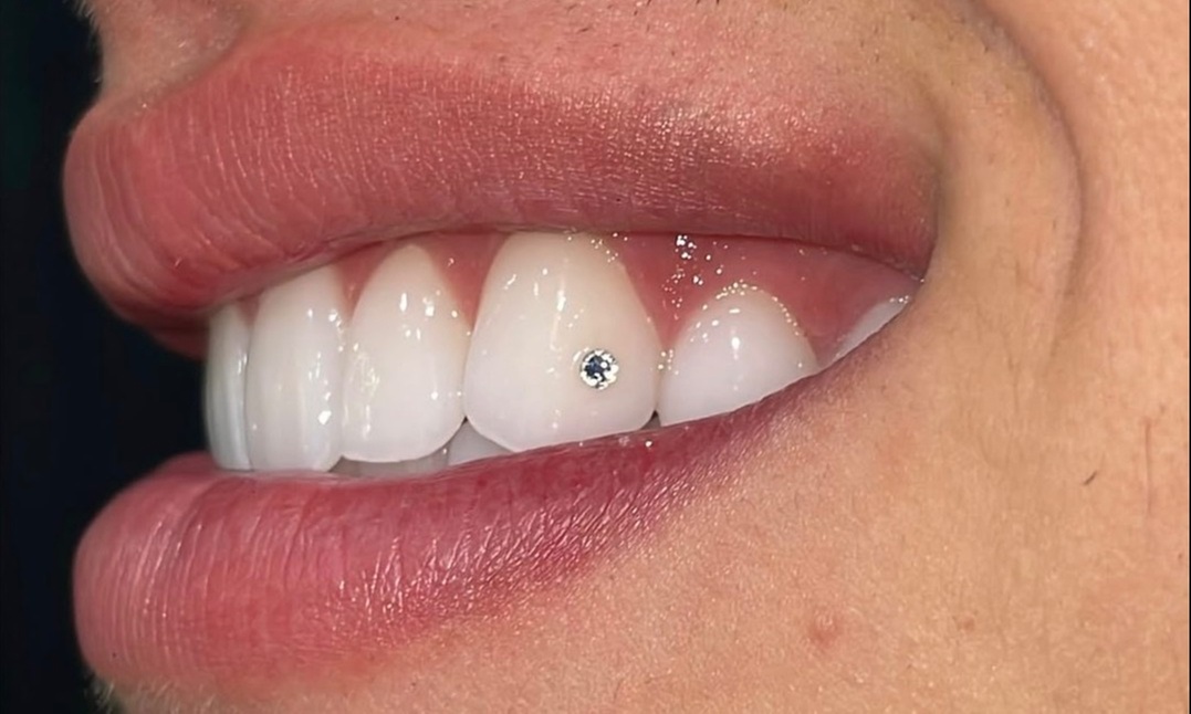 Brighten Your Smile with Tooth Gems